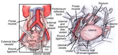 Relation of the uterine artery to the ureter durin