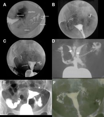 Examples of hysterosalpingogram (HSG) images showi