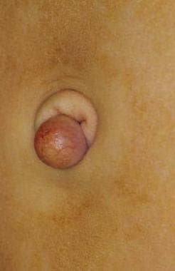 Urachal cyst at level of umbilicus. 