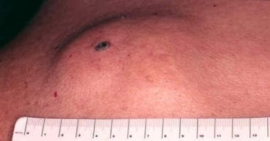 Unusually large epidermoid cyst with a prominent p