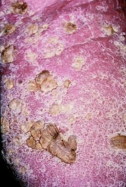Arsenical keratosis on the sole of a carpenter. 