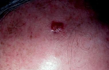 A leiomyosarcoma of the scalp to be excised and cl