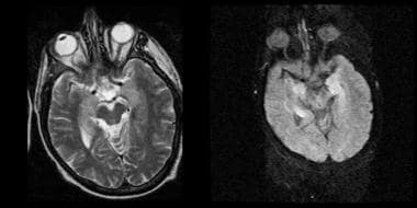 Paraneoplastic encephalomyelitis. 