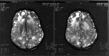 T2-weighted MRIs show encephalomalacia after shake