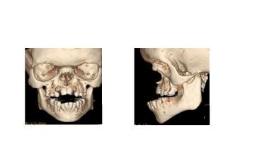 Three-dimensional facial CT scans in the same chil