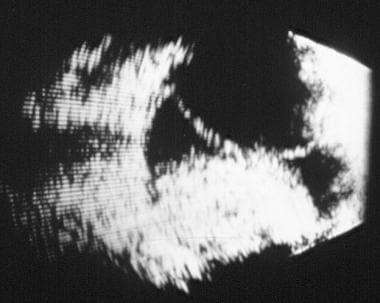 B-scan ultrasonography examination of choroidal de