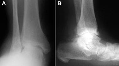 Anteroposterior and lateral radiographs of lower e