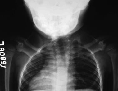 Posteroanterior chest radiograph. This image depic