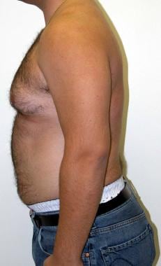 Man boobs (gynecomastia) could indicate serious health problems