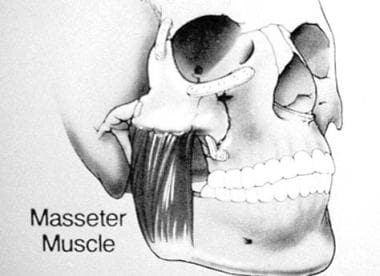 Anatomic depiction of the masseter muscle as it re