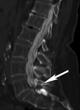Spinal stenosis with fixed degenerative spondyloli