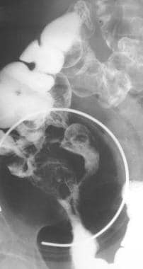 Crohn disease. Enterocolic fistula in a patient wi
