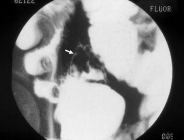 Inflammatory bowel disease. This computed tomograp