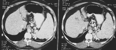 Computed tomography scan showing esophageal varice