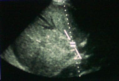 Sonogram showing hepatic vein thrombus, with new v