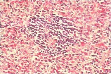 Systemic mastocytosis. Lymph node biopsy, chloroac