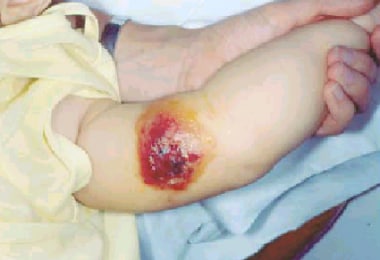 Seven-month-old infant with anthrax. In this infan