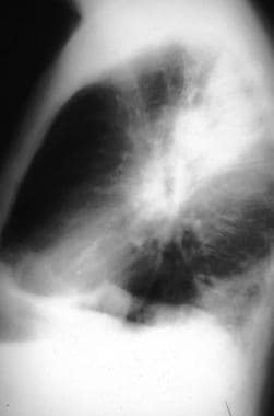 Lobar consolidation with pneumococcal pneumonia. L