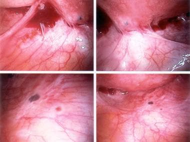 Active endometriosis with red and powder-burn lesi