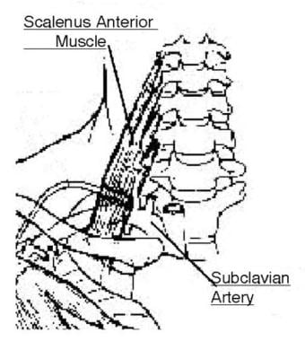 The anatomy of the subclavian artery in the thorac