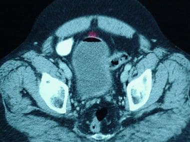 A lower cut of the CT scan from the related image.