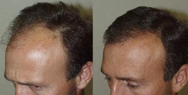What is Expecting you After Hair Transplant? | 4 Steps to Dream Hair