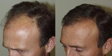 Fue Hair Transplant In Bangalore Fue Hair Transplant Cost Find Best  Reviewed Hospitals  Surgeons Reviews  Practo