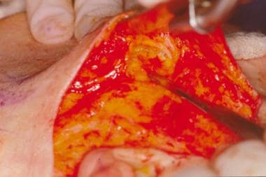 Developing the deep-plane portion of the dissectio