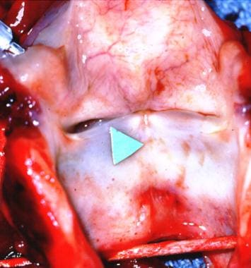 A surgical specimen after laryngectomy. The arrow 