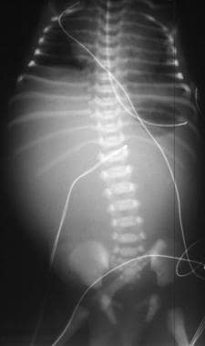 Abdominal radiography revealing a single gastric b