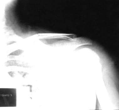 Nondisplaced middle clavicle fracture. 
