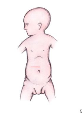 Pediatric duodenal atresia. Incision for duodenal