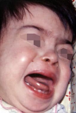 Hypodontia in patient with Down syndrome. Image co