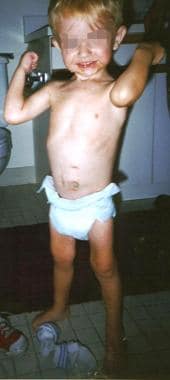 The same child as in the previous images, at age 3