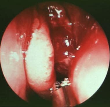 How to Tell If You Have Nasal Polyps - Keck Medicine of USC