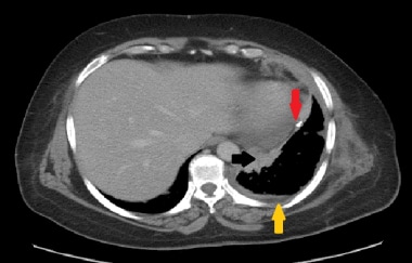 Axial slice from staging CT scan of a 67-year-old 