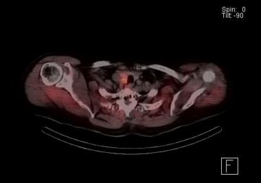 Sestamibi parathyroid scan with SPECT scan. The or