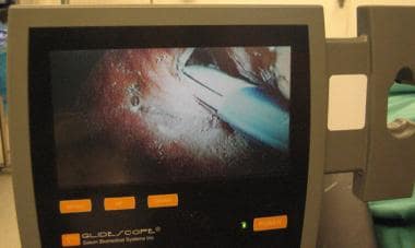 GlideScope monitor view. Endotracheal tube is visu