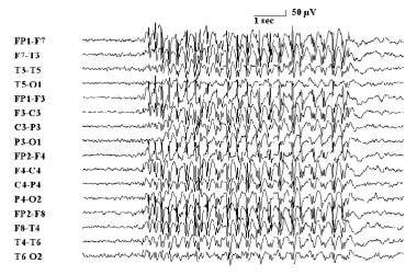 Absence seizure eeg