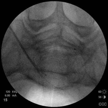 Axial fluoroscopy view shows the catheter around t