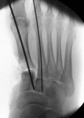 open fracture x ray