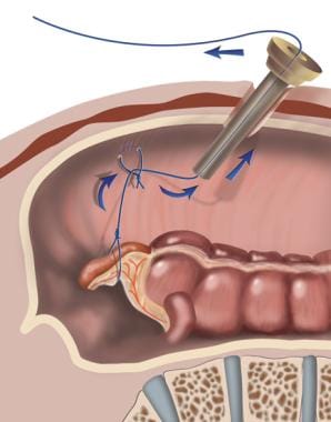 After string attached to appendix is threaded thro