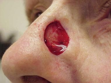 A deep surgical wound on the lateral nasal sidewal
