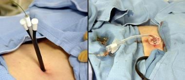 Jejunostomy tube replacement. After tube dislodgem