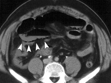 Pneumatosis of bowel wall. 