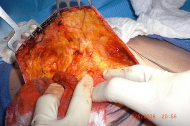 Superior flap dissection. 