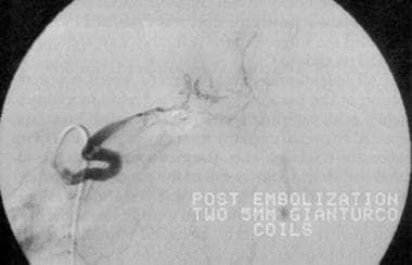Postembolization angiogram depicting successful co