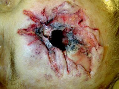 Stellate hard contact wound of the head. Note the 
