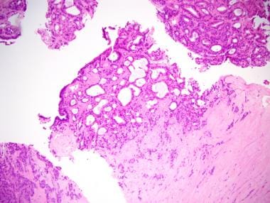 intraductalis papilloma patofiziológia medscape a condyloma tumor