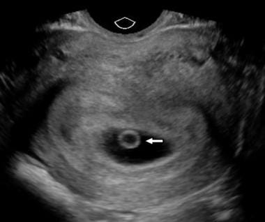 Coronal transvaginal image through the uterus demo